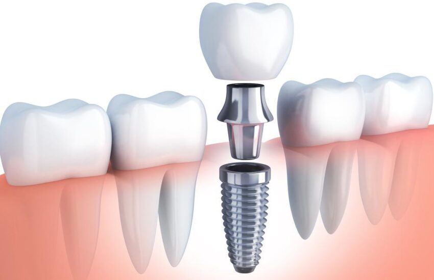 How Should You Prepare For Dental Implant Surgery