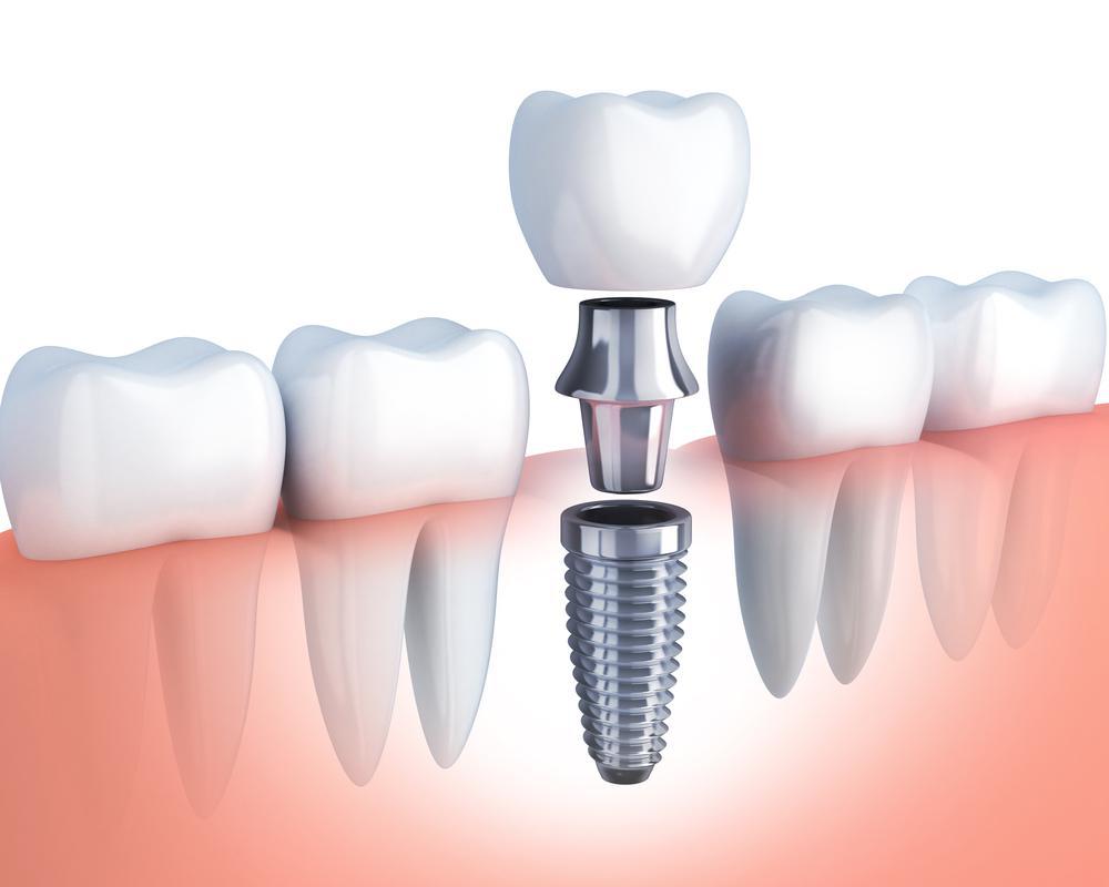 How Should You Prepare For Dental Implant Surgery
